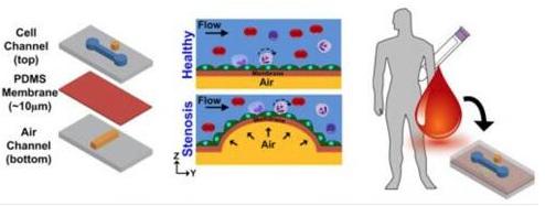 在芯片上实现动脉粥样硬化的模拟，并在心脏病发作前评估血管的狭窄和血液的健康状况
