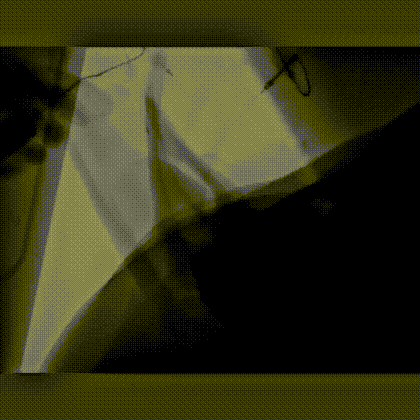 猪耳血管造影，可见枝枝杈杈很多