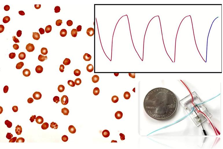 微流控阻抗传感器可以监测镰状细胞病
