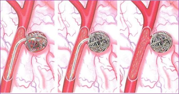 可拉伸的无线传感器可以监测脑动脉瘤的愈合 可拉伸的无线传感器可以监测脑动脉瘤的愈合