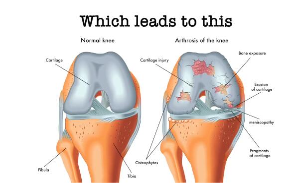 微流控“软骨”芯片（Knee On Chip）用于关节炎研究