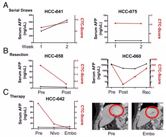 图4.CTC评分较血液AFP检测系统能够更灵敏、更特异地检测肝癌及监控肝癌的治疗情况。