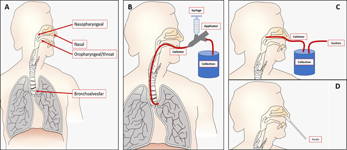 用于呼吸道病毒检测的微流体样品制备